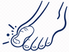 Hallux valgus (knobbel bij grote teen)